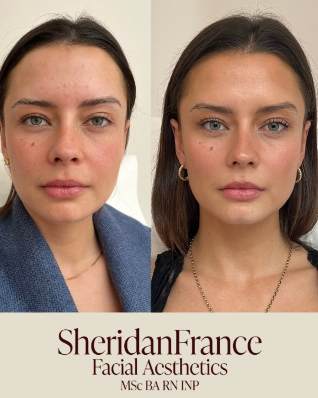Liquid facelift treatment — Sheridan France, Fitzrovia