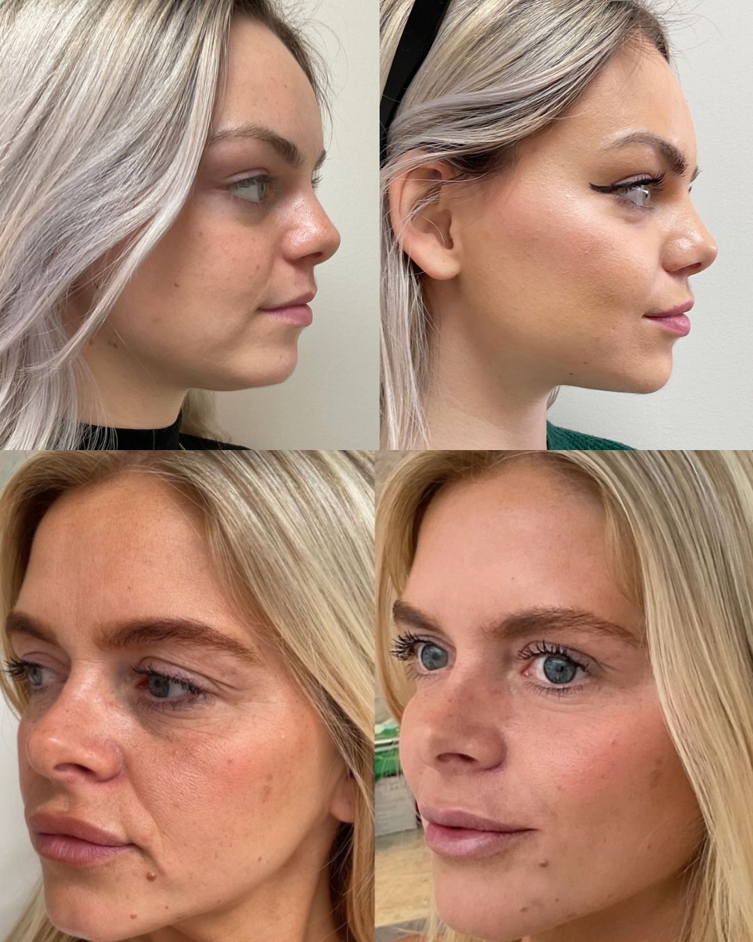 Liquid facelift before and after — Sheridan France